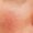Calm and Comfort "Rosacea and Couperose”