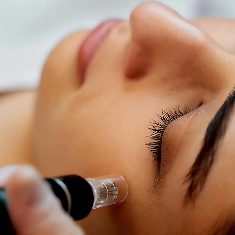 microneedling-01